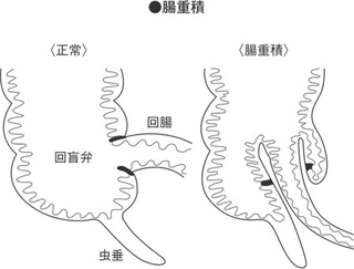 腸重積.jpg