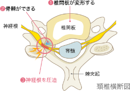 頚椎症性神経根症.png